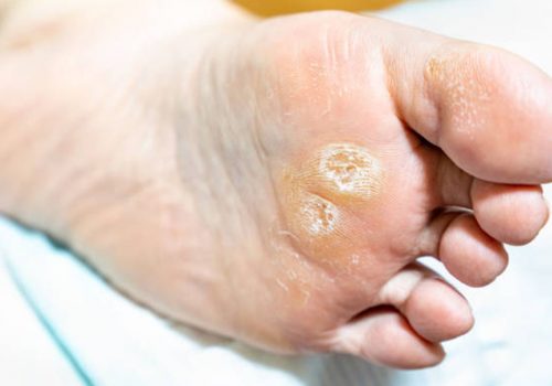 callus, hard skin