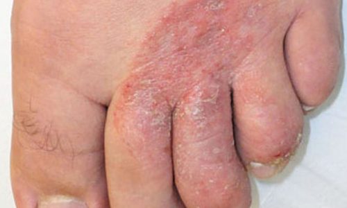 athletes foot, tinea pedis, fungal skin infection