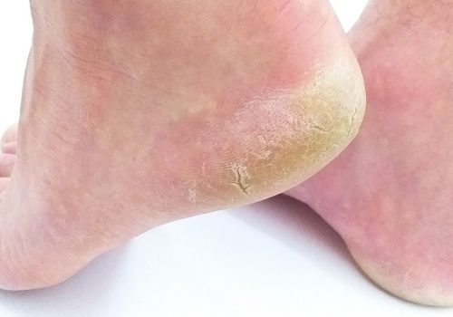 cracked heels, callus, fissures